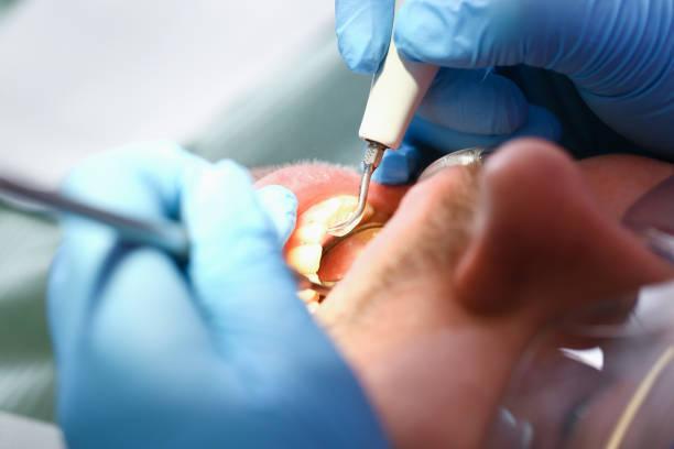 Best Emergency Dental Care for Broken or Chipped Teeth in New Sharon, IA