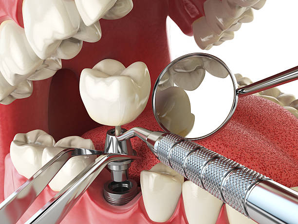 Best Emergency Dental Care for Broken or Chipped Teeth in New Sharon, IA